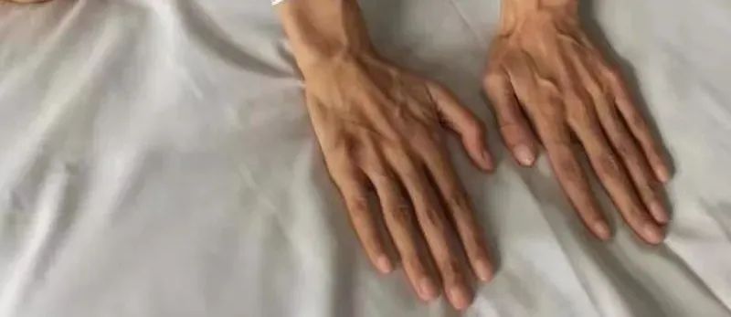 13岁女孩身高超1米7，确诊为罕见病！身体出现这个情况要当心&rarr;