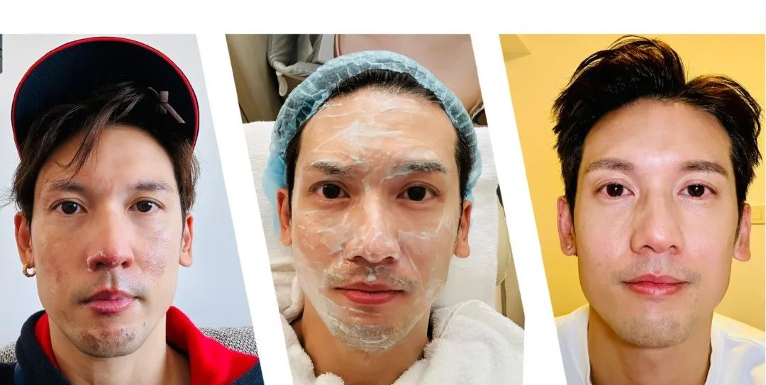 知名男艺人自曝脸部二级烧伤！紧急提醒&rarr;