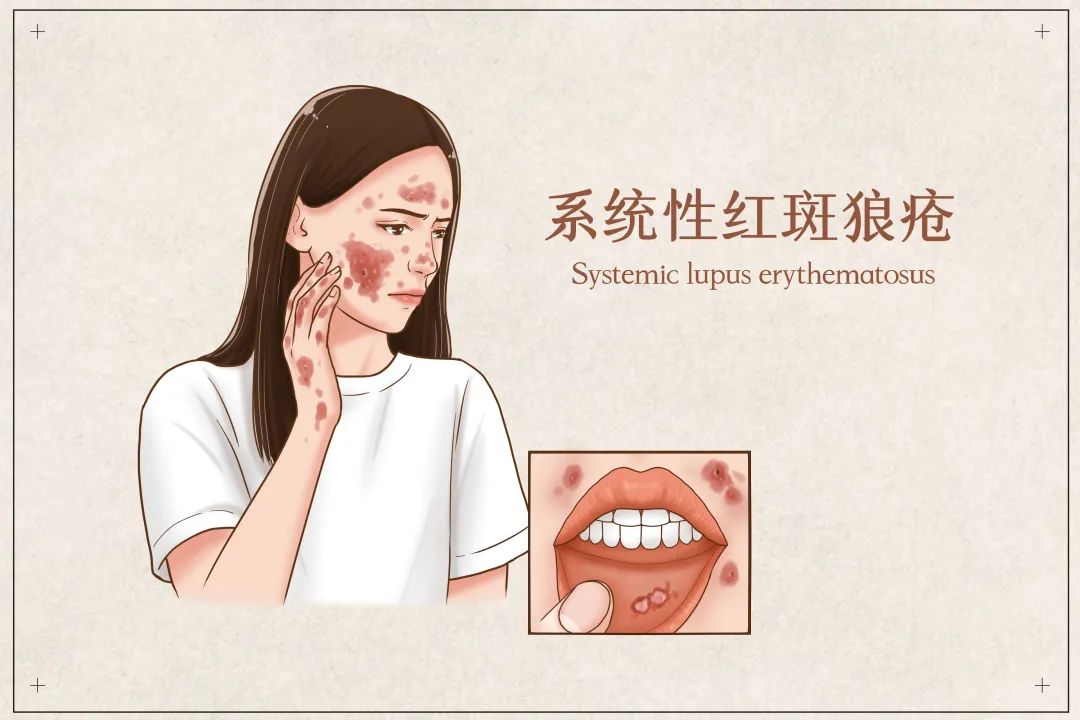 &ldquo;红斑狼疮&rdquo;冲上热搜，这种&ldquo;不死的癌症&rdquo;尤其偏爱女性！