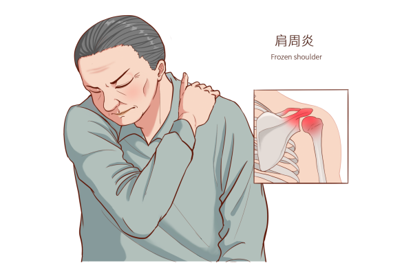 打工人难免&ldquo;肩&rdquo;负重任，肩膀痛=肩周炎？医生有话说