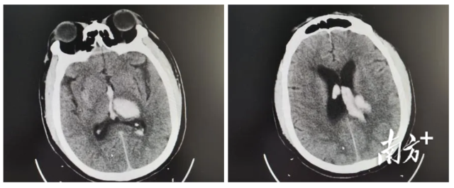 独居男子突发脑出血，高明医生与死神&ldquo;抢人&rdquo;